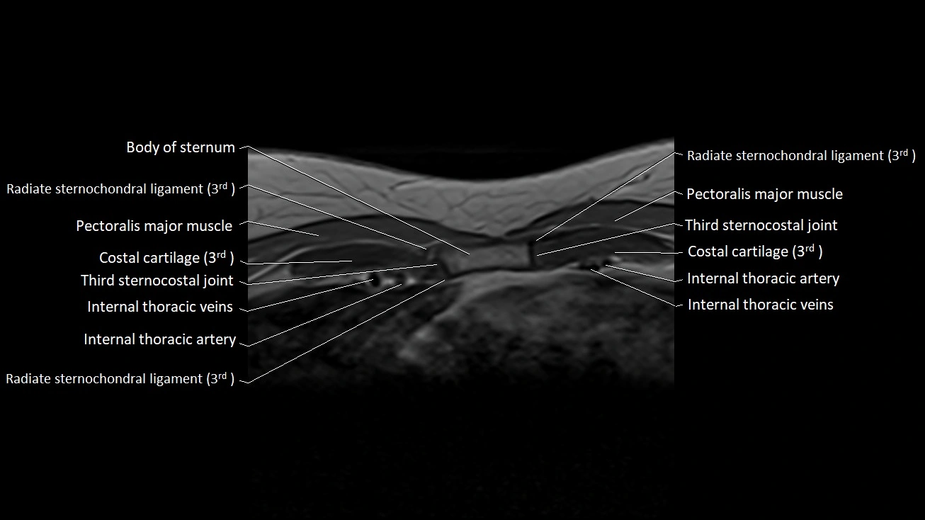 MRI sternum and sternoclavicular joint labeled axial anatomy image 18.webp